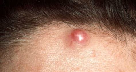 Cyst On Forehead Causes Symptoms Pictures Sebaceous Cyst White
