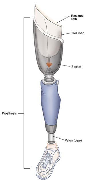 Learning To Use A Prosthesis Saint Luke S Health System