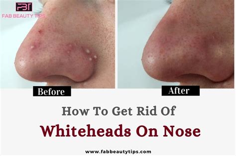 How To Get Rid Of Whiteheads On Nose Fab Beauty Tips