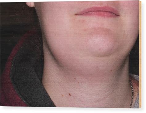Swollen Lymph Glands In Neck Photograph By Dr P Marazzi Science Photo