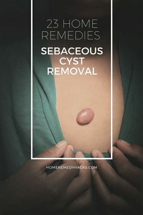 Home Remedies For Sebaceous Cyst Removal Cysts Epidermoid Cyst Home