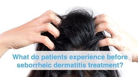What Do Patients Experience Before Seborrheic Dermatitis Treatment