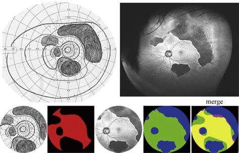 Wide Field Fundus Autofluorescence Imaging To Evaluate Retinal Function