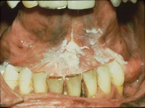 Dentistry Lectures For Mfdsmjdfnbdeore Facts On Leukoplakia