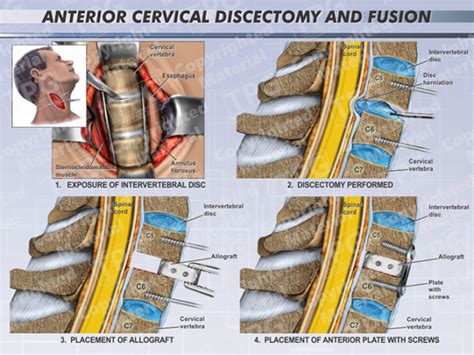 Anterior Cervical Discectomy Fusion Two Level Order