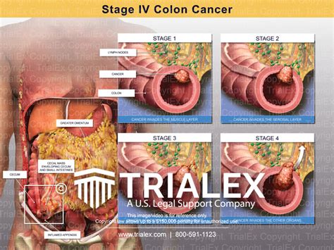 Stage Iv Colon Cancer Trial Exhibits Inc
