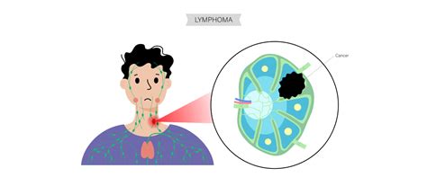 Lymphoma Cancer Symptoms Causes Types And Treatment