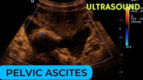 Pelvic Ascites Due To Dilated Cardiomyopathy On Ultrasound Youtube