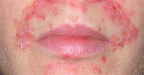 Dermatitis Herpetiformis Kožna Celijakija Duhringova Bolest Uzrok
