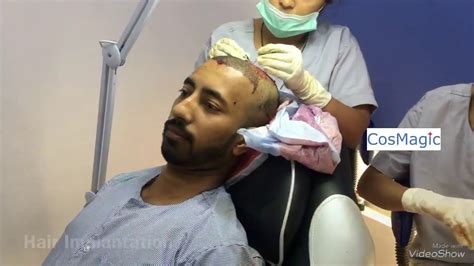 Hair Transplant In Mumbai Dubai Patient Youtube