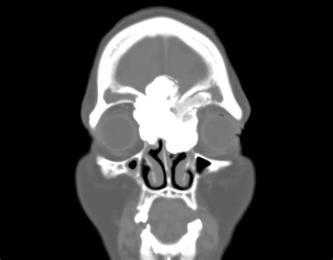 Ivory Osteoma Image