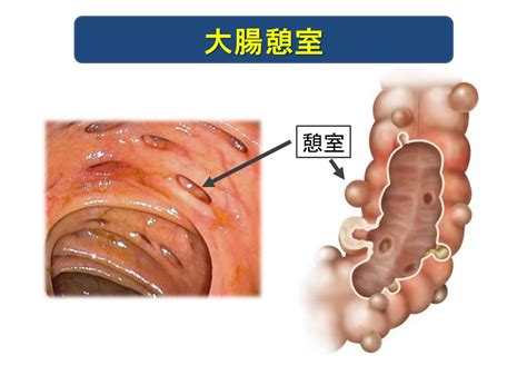 【解説】大腸憩室症とはどんな病気どんな人が発症しやすい ゆるふわ医書