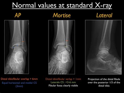 Normal Values At Standard X Ray Views Ap Mortise And Lateral Of The Download Scientific