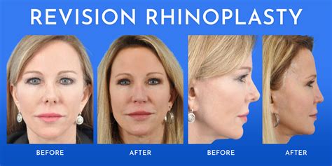 Rhinoplasty 101 What Are The Different Types Of Rhinoplasties
