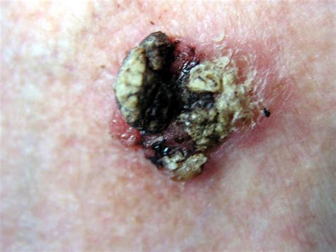 Malignant Lesions Squamous Cell Carcinoma Scc Picture Hellenic