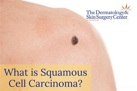 What Is Squamous Cell Carcinoma Wilmington Dermatology