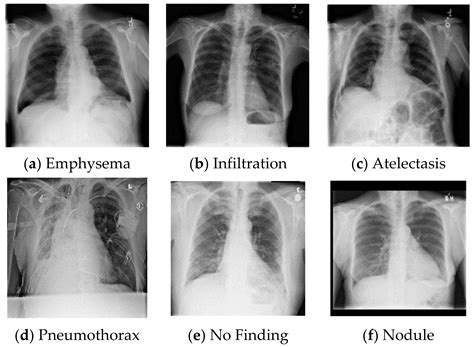 Anatomy Of Chest X Ray Normal Chest Xray Stock Photo Download Image