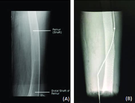 X Ray Image Of Human Limb A And Sagittal B View Of Phantom Model