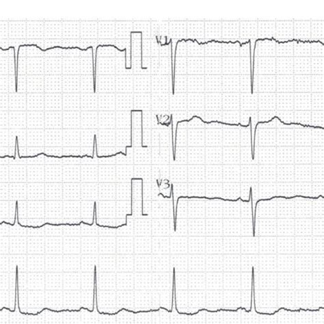 Ecgs Showing A Sinus Rhythm With Prolonged Pr Interval Of 260 Ms