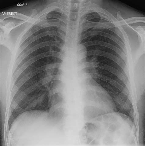 Chest Radiograph With Bilateral Hilar Lymphadenopathy And Bilateral