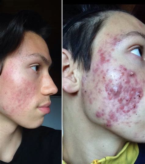 Accutane Before And After Scars