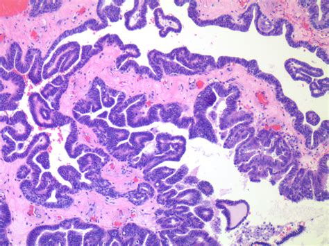 Serous Cystadenoma Histology
