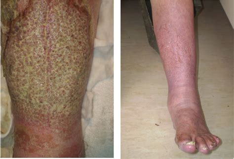 Eczema Legs