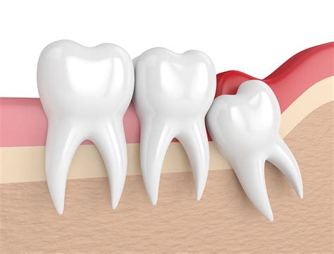 Wisdom Teeth Surgery — Dr Zeb Mcnamara · Oral Dental Implant