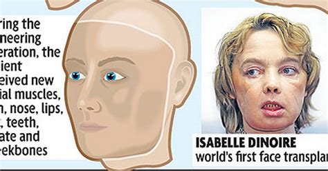 Patient Well After Radical Full Face Transplant Mirror Online