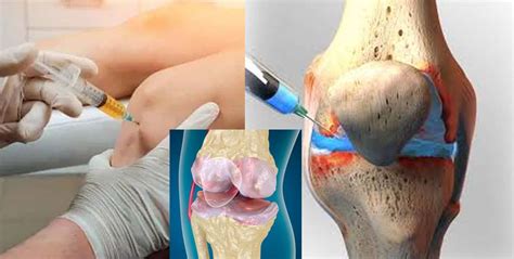 Corticosteroid Injections Used To Treat Osteoarthritis Pain In The Hip