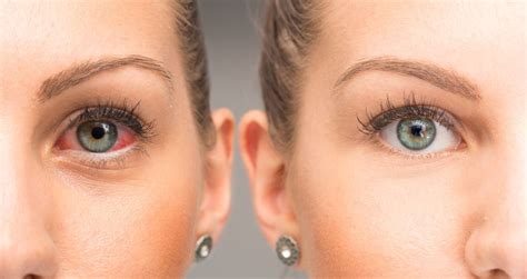 Red Eyes Infection Causes Symptoms And Treatment Bloodshot Eyes