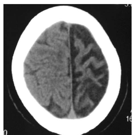 Brain Ct Scan Showing Progressive Left Cerebral Atrophy With