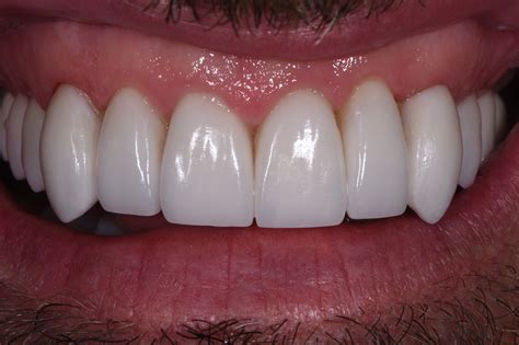 Enamel with a laser or drill. Vampire Teeth | Fang Feels | Cosmetic Dentist Auckland