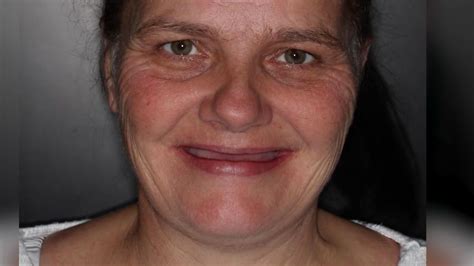 Amazing Transformation Of Grandmother Who Lost Her Teeth To A Mouth