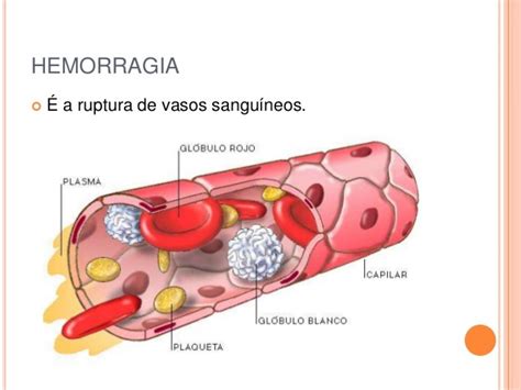 Hemorragia Venosa E Arterial