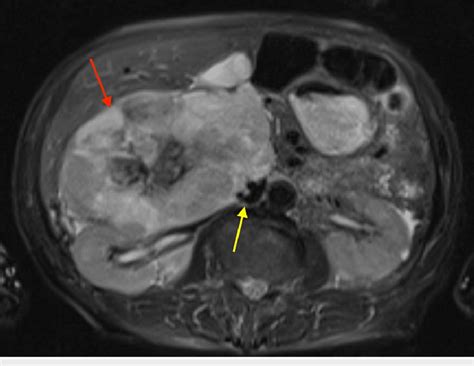 Mri Adrenals With And Without Contrast Axial View Revealing A Large