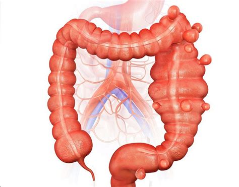 Doen A Diverticular Dos C Lons Dr Sandro Dini