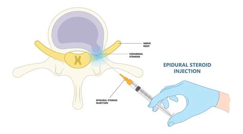 Comparing Prp And Steroid Injection For Back Pain Joint Rehab And