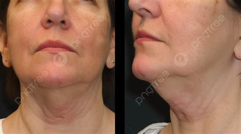 The Woman S Neck Before And After Neck Lift Background Pictures Of A