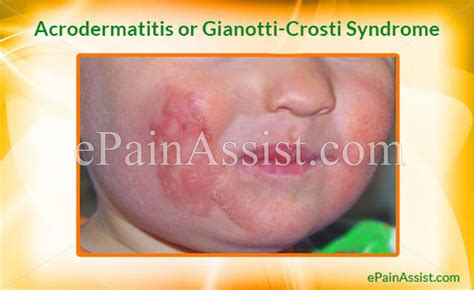 Acrodermatitis Or Gianotti Crosti Syndromecausessignssymptoms