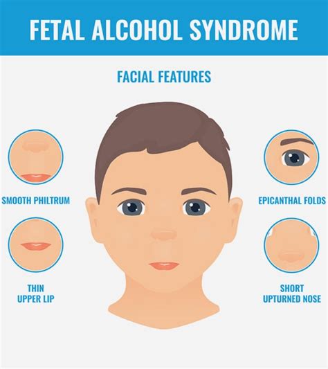 Fetal Alcohol Syndrome Fas Causes Symptoms And Treatment