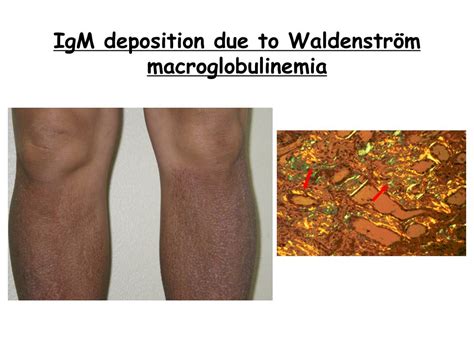 Ppt Waldenström Macroglobulinemia Powerpoint Presentation Free