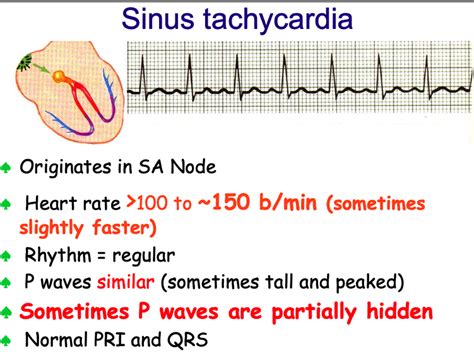 Sinus Tachycardia
