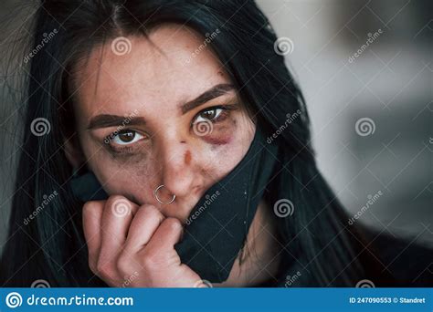 Portrait Of Beaten Young Woman In Black Protective Mask With Bruise