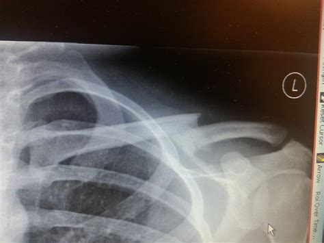 Broken Collar Bone Recovery Time Page 31 Pinkbike Forum