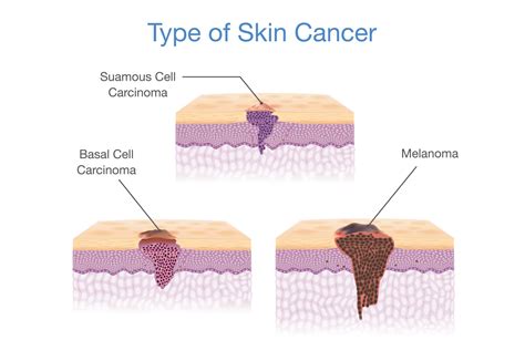 How To Detect The Different Types Of Skin Cancer Jupiter Dermatology And Hair Restoration