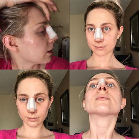 Nose Job Surgery Recovery Cast Removal And Two Week Post Op Reveal
