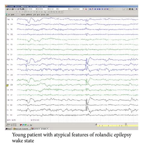 Rolandic Epilepsy With Atypical Features Progressive Cognitive