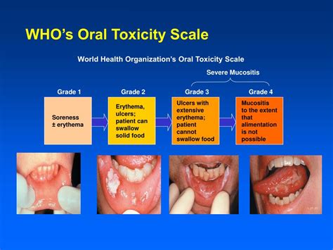 If you have nasopharyngeal cancer, you might easily mistake the symptoms for other conditions. PPT - Coding for Mucositis PowerPoint Presentation, free ...