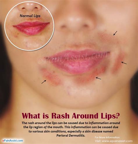 What Causes Rashes Around The Lips And Treatments To Get Rid Of It